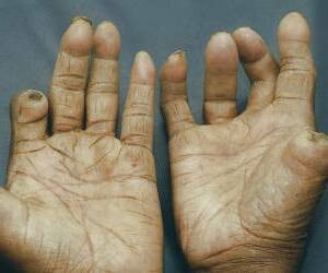 بررسی جامع بیماری جذام: از عوامل ایجادکننده تا نشانه‌ها و درمان