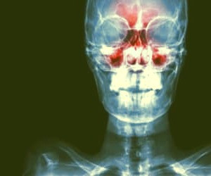 بهترین راهکارهای خانگی و طبیعی برای تسکین درد سینوس