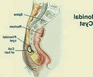 بررسی علل و درمان خانگی کیست مویی مقعد