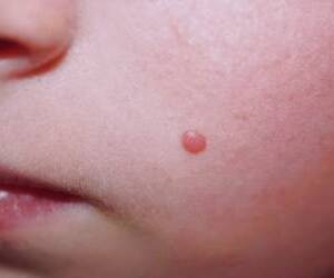 پوست روی قرمز خال علائم و دلایل