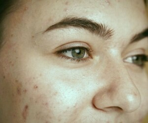 چگاه جوش: اطلاعات مفید برای درمان و پیشگیری