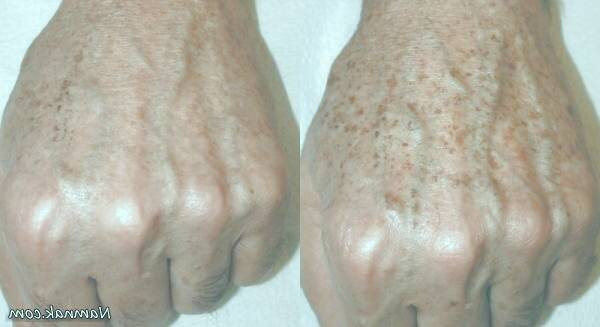 از بین بردن لکه های قهوه ای روی پوست با درمان خانگی لک های پوستی