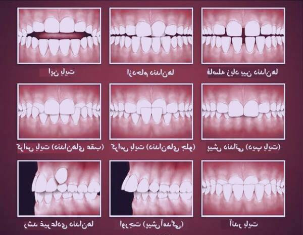 بررسی سوالات مهم پیش از درمان ارتودنسی دندان