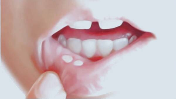 زخم های ریز در دهان