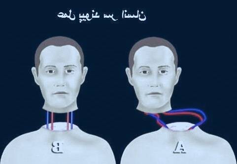 عمل پیوند سر انسان