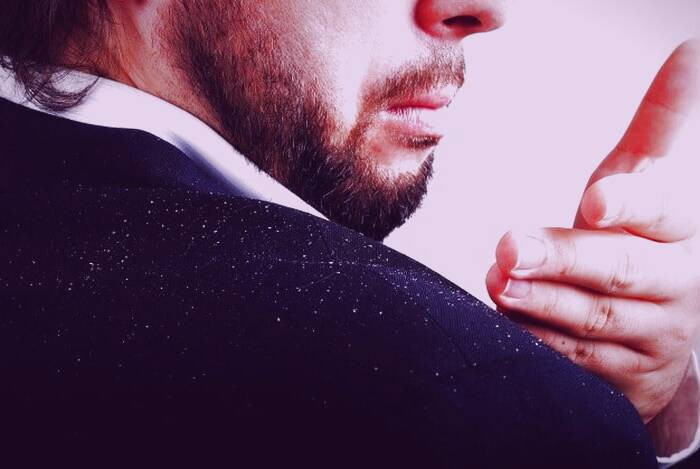 درمان شوره سر