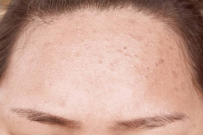 جوش سر سیاه