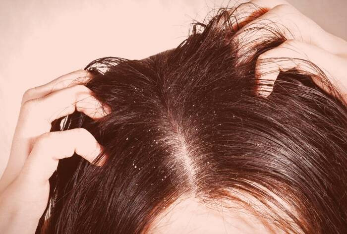 درمان شوره سر 