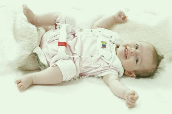 علائم در رفتگی مادرزادی لگن