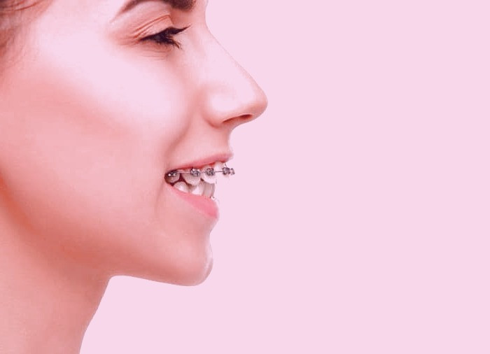 روش تمیزی ارتودنسی