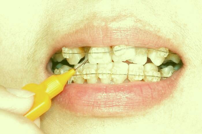 نحوه مراقبت از دندان ارتودنسی