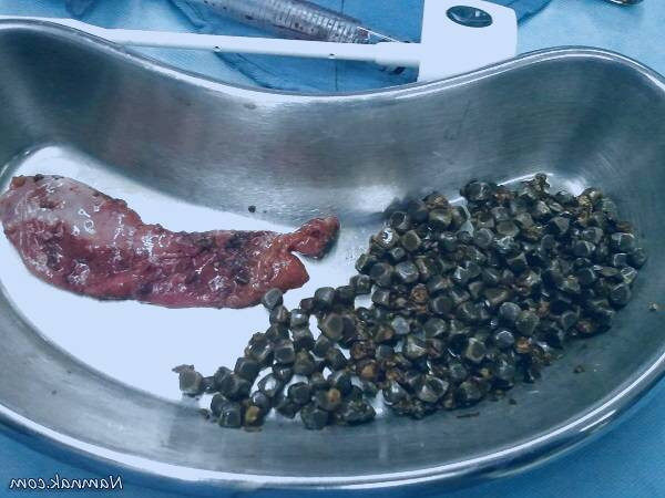 سنگ کیسه صفرا 