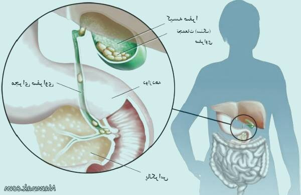 سنگ کیسه صفرا