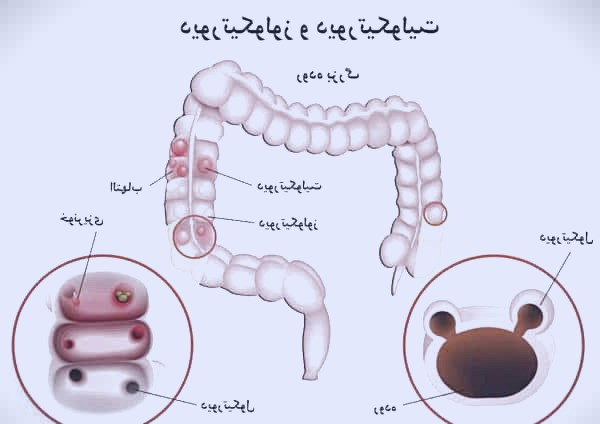 دیورتیکولیت