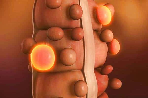 دیورتیکولوز