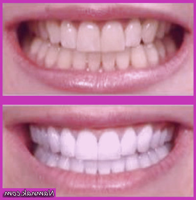 جرمگیری چگونه انجام می شود