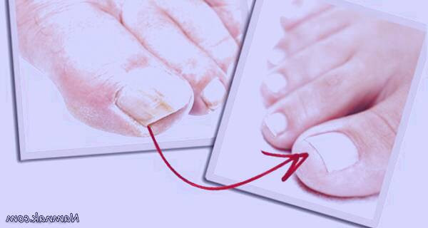 علت عفونت ناخن شست پا 