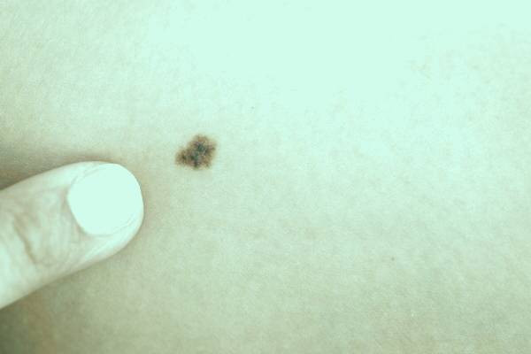 خال سرطانی ملانوم 