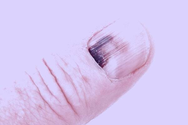 ملانوم ناخن