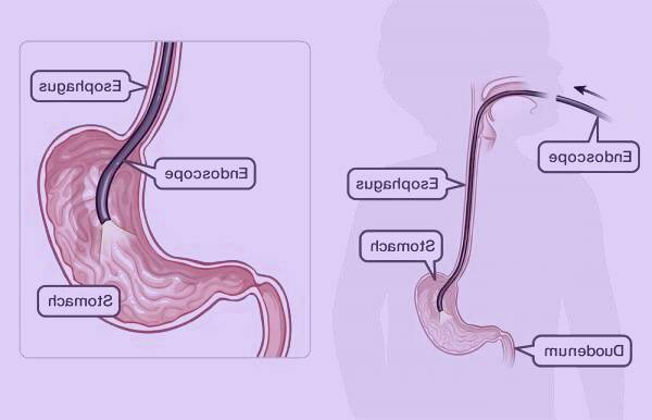 بهبود روش های مراقبت قبل و پس از آندوسکوپی معده در کودکان