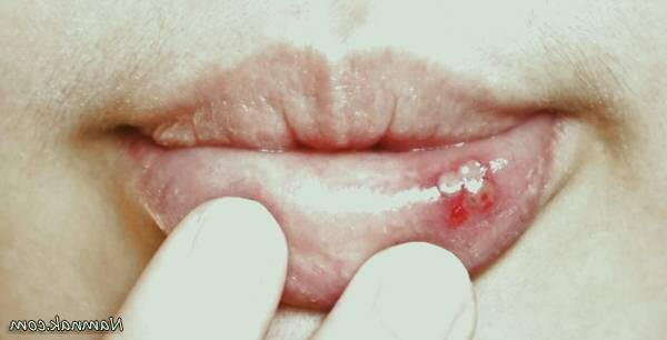 زخم های دهان
