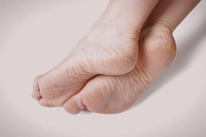 ترک پاشنه پا