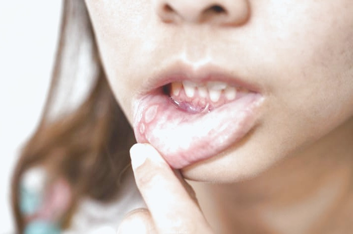 آفت دهان نشانه چیست