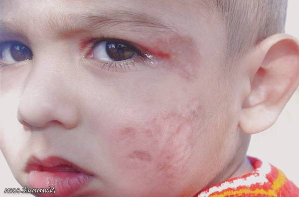 بیماری سالک