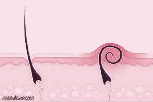 موهای زیرپوستی 