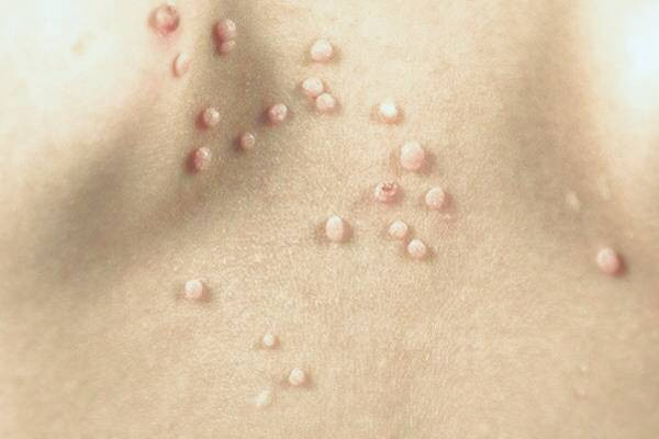 مولوسکوم تناسلی در زنان 