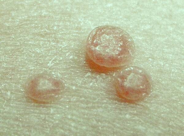 انواع مولوسکوم