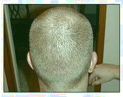 کاشت و موی سر در کلینیک معتبر با تصاویر