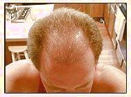 کاشت و موی سر در کلینیک معتبر با تصاویر