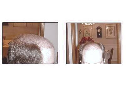 کاشت و موی سر در کلینیک معتبر با تصاویر