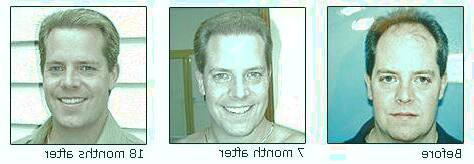 کاشت و موی سر در کلینیک معتبر با تصاویر