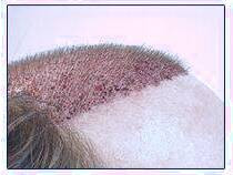 کاشت و موی سر در کلینیک معتبر با تصاویر