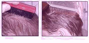 کاشت و موی سر در کلینیک معتبر با تصاویر
