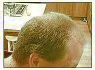 کاشت و موی سر در کلینیک معتبر با تصاویر