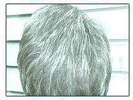 کاشت و موی سر در کلینیک معتبر با تصاویر