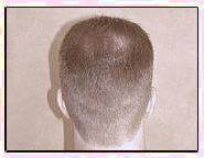 کاشت و موی سر در کلینیک معتبر با تصاویر