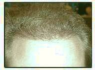 کاشت و موی سر در کلینیک معتبر با تصاویر