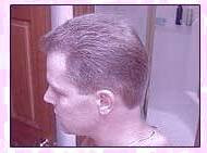 کاشت و موی سر در کلینیک معتبر با تصاویر