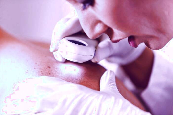 لکه های نوروفیبروماتوز