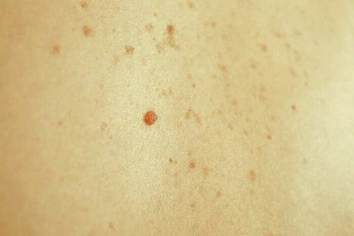 لکه پوست پا