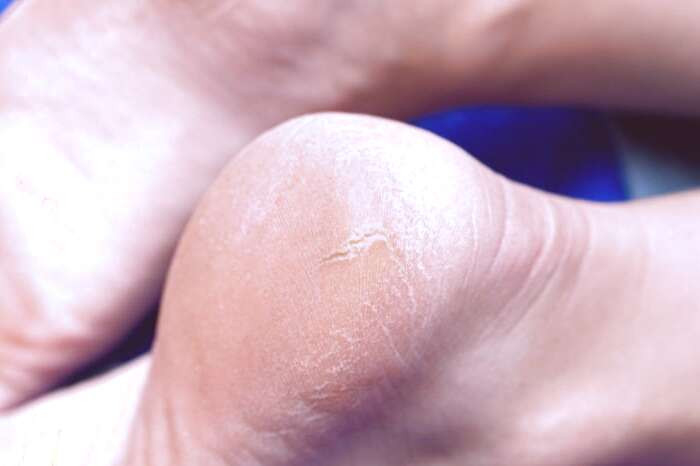 مراقبت از پاها