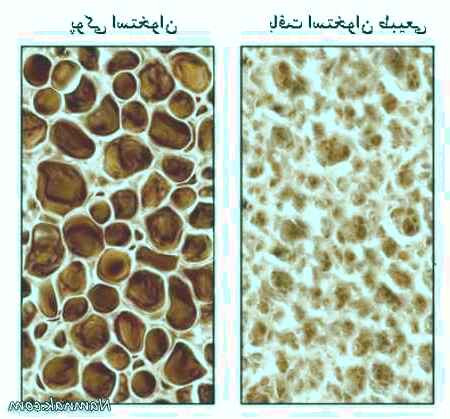 درمان پوکی استخوان