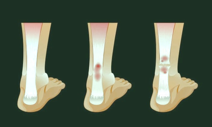 شکستگی بسته