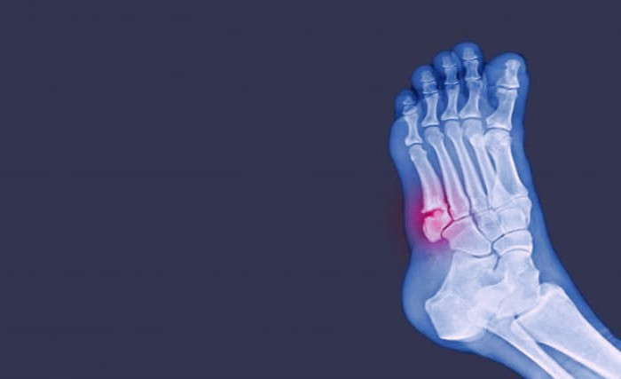 شکستگی مویی