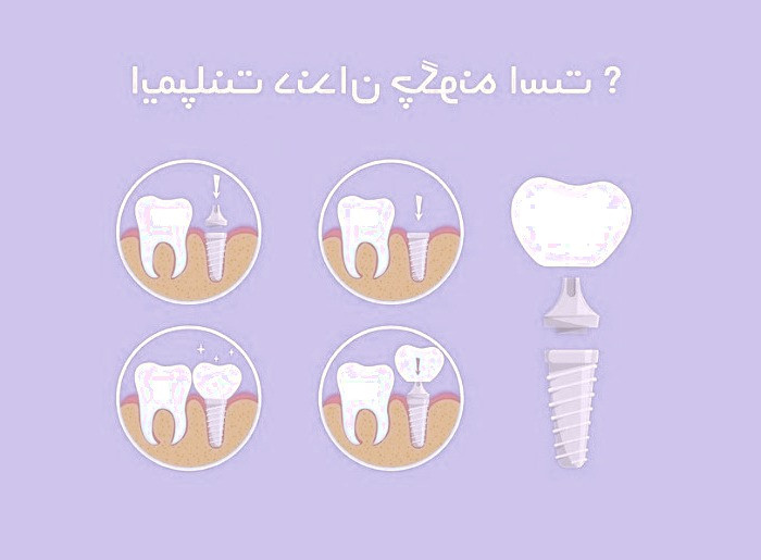 ایمپلنت دندان: راهکاری مؤثر برای دندان‌های از دست رفته