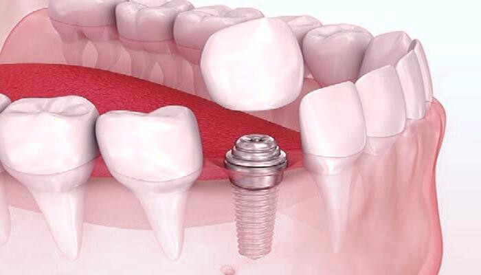 ایمپلنت دندان: راهکاری مؤثر برای دندان‌های از دست رفته